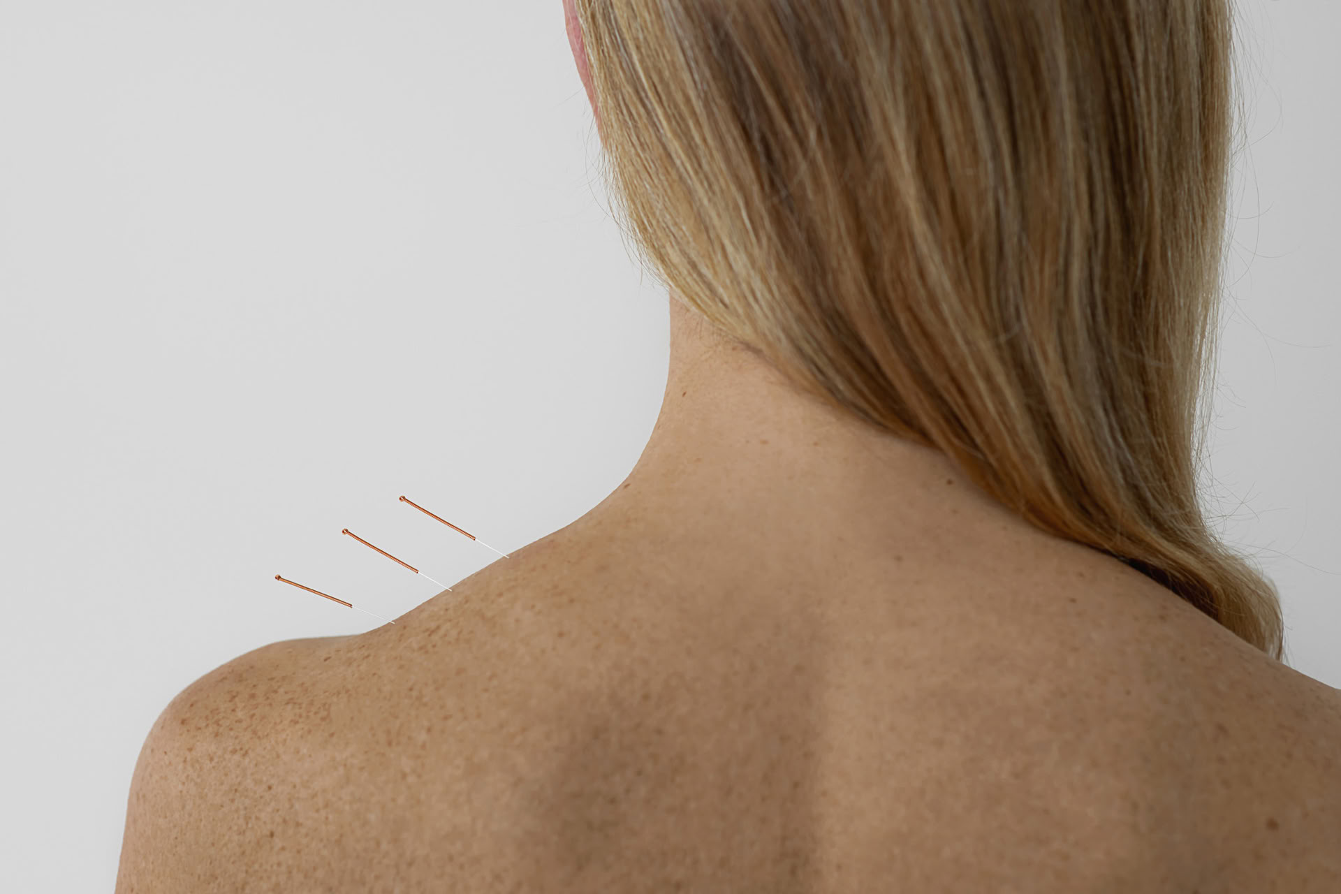 Acupunctuur