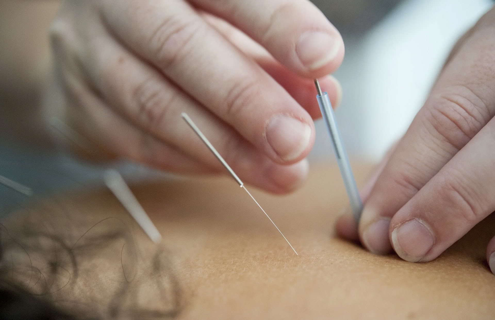 $95 Eerste bezoek - acupunctuursessie