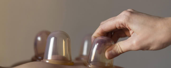 Cuppingmassage