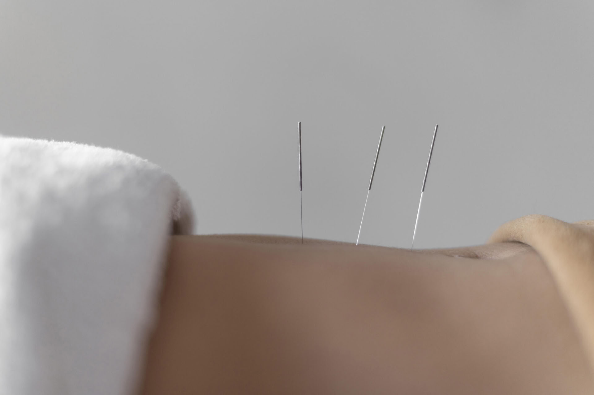 Acupunctuur