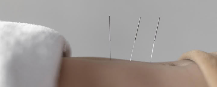 Acupunctuur