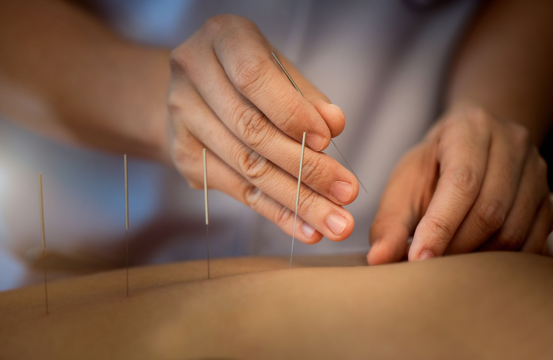 Acupunctuur 1-op-1 therapiesessie in Ubud