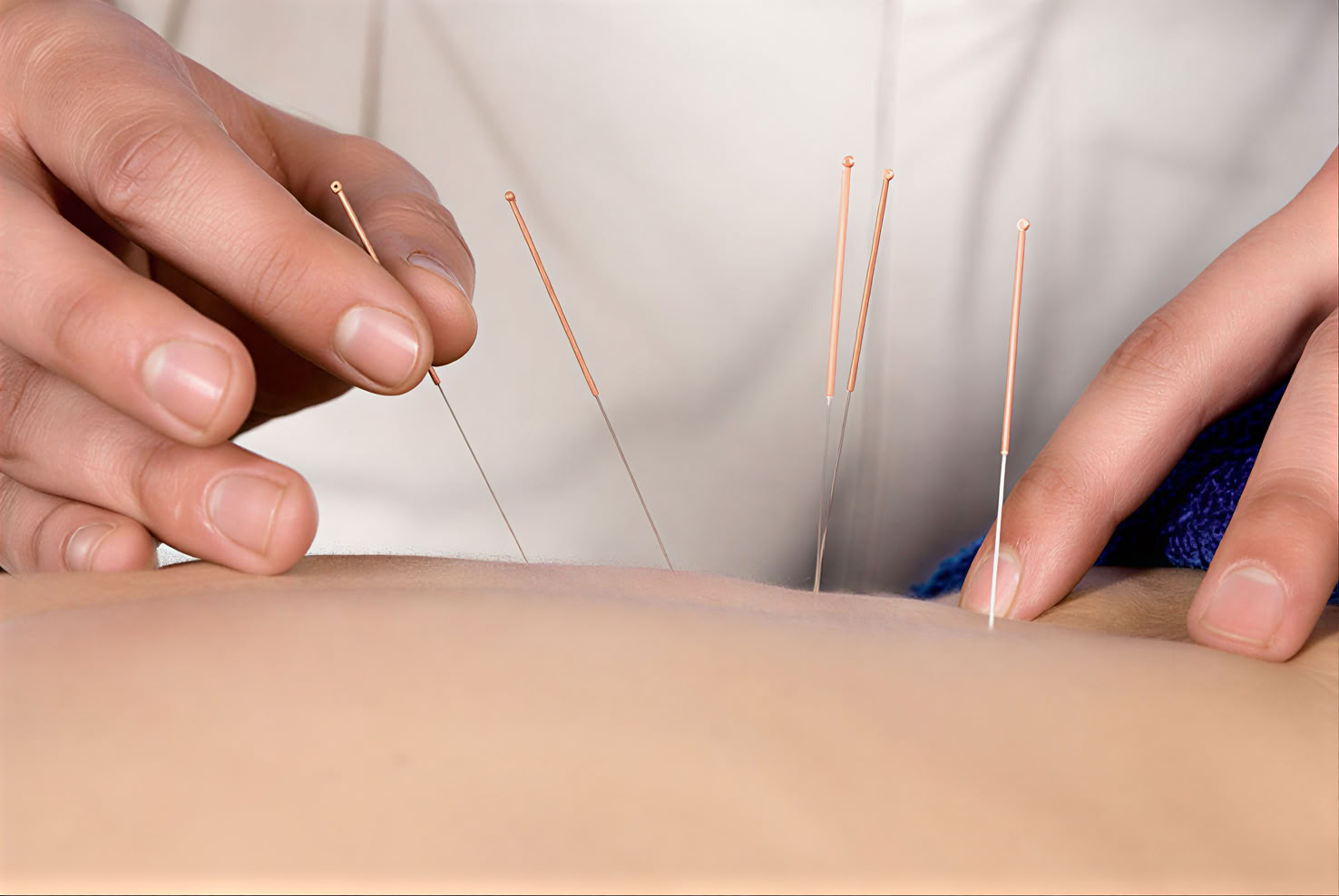 Acupunctuur 1-op-1 therapiesessie in Ubud