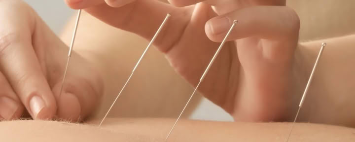 Acupunctuur 1-op-1 therapiesessie in Ubud